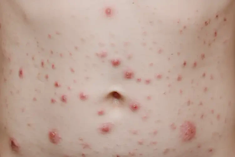 小學(xué)生肚子容易長濕疹能夠徹底治愈嗎(圖4)