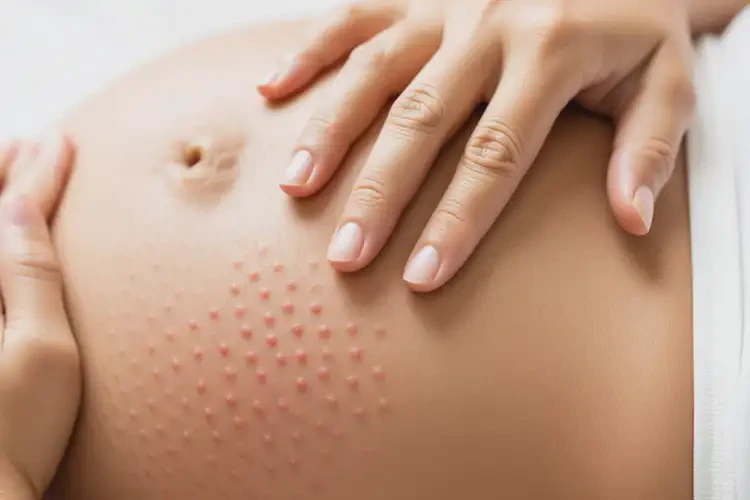 產(chǎn)婦肚子上偶爾長(zhǎng)濕疹可不可以徹底自愈(圖1)