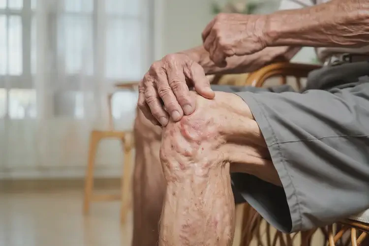 高齡老人大腿有濕疹能夠徹底治愈嗎(圖3)