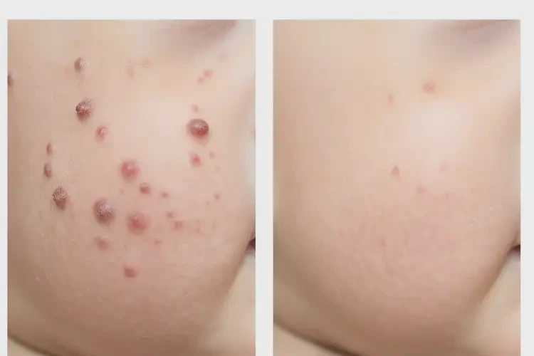 嬰幼兒手臂上偶爾起濕疹不管它會自己好嗎(圖2)