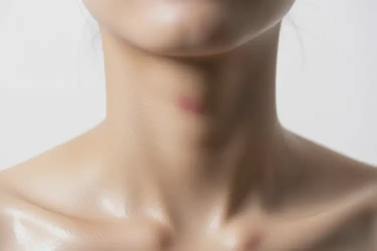 女人脖子上偶爾起濕疹能夠徹底治愈嗎(圖3)