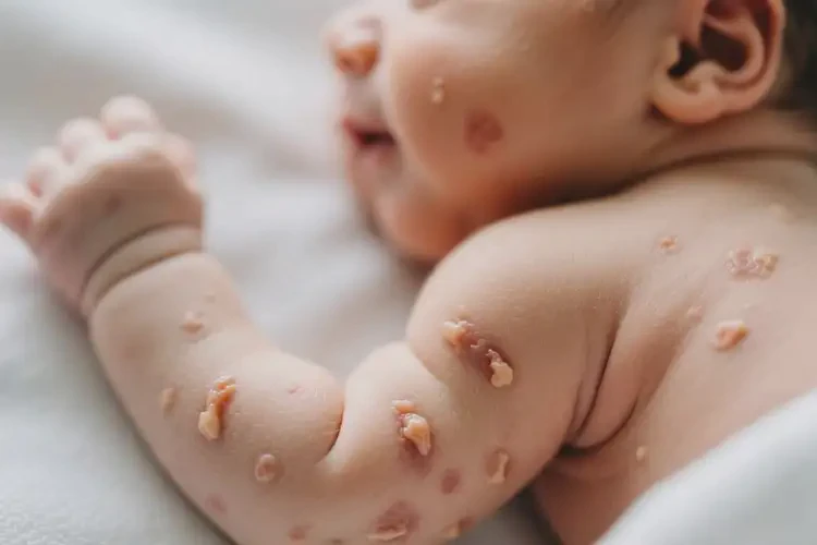 新生兒手臂上有濕疹能徹底自愈嗎(圖3)