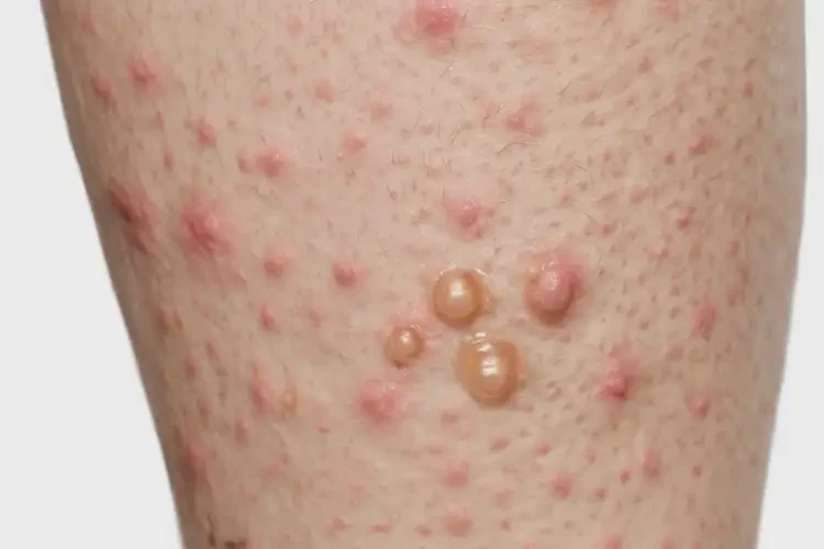 大学生脚上偶尔长湿疹不管它会自己痊愈吗(图4)