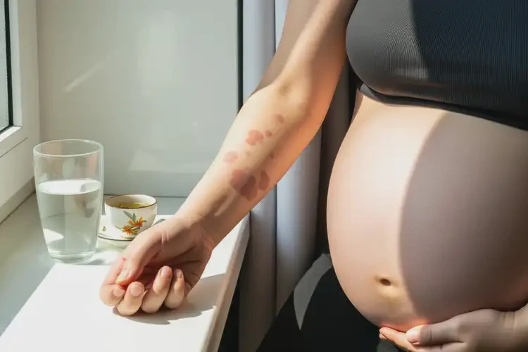 孕婦身上經(jīng)常起濕疹不管它會自己痊愈嗎(圖2)