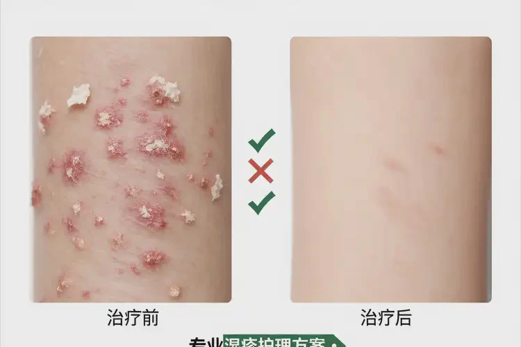 小兒身上有濕疹能靠自己自愈嗎(圖1)