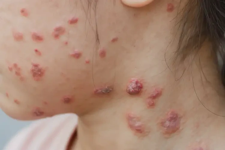 青少年脖子經(jīng)常起濕疹不管它會(huì)自己好嗎(圖4)