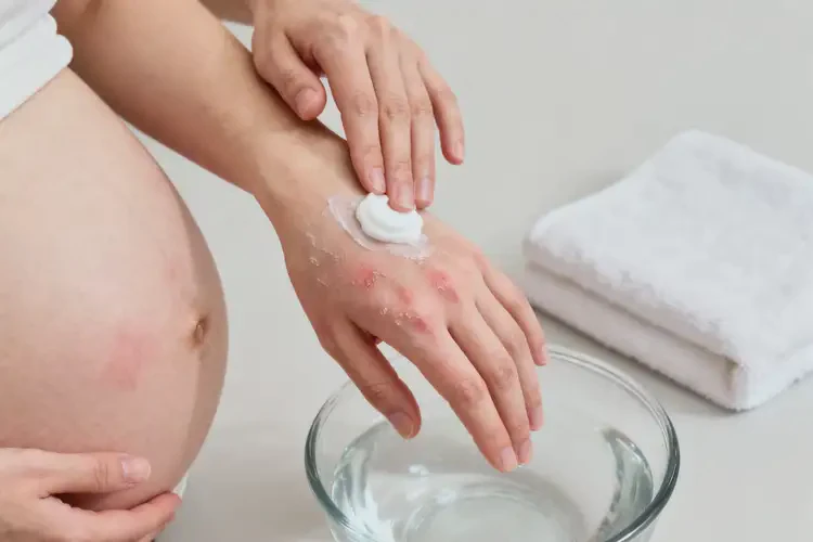 孕婦手上有濕疹不管它會(huì)自己好嗎(圖4)