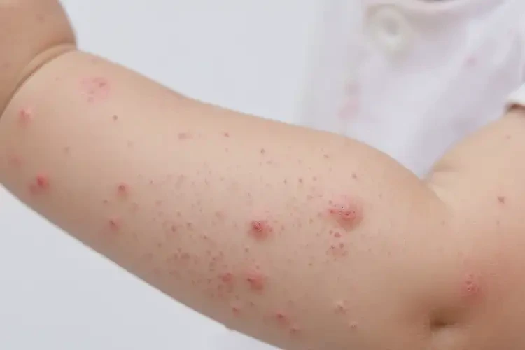 小孩手臂經(jīng)常起濕疹不管它會(huì)自己自愈嗎(圖4)