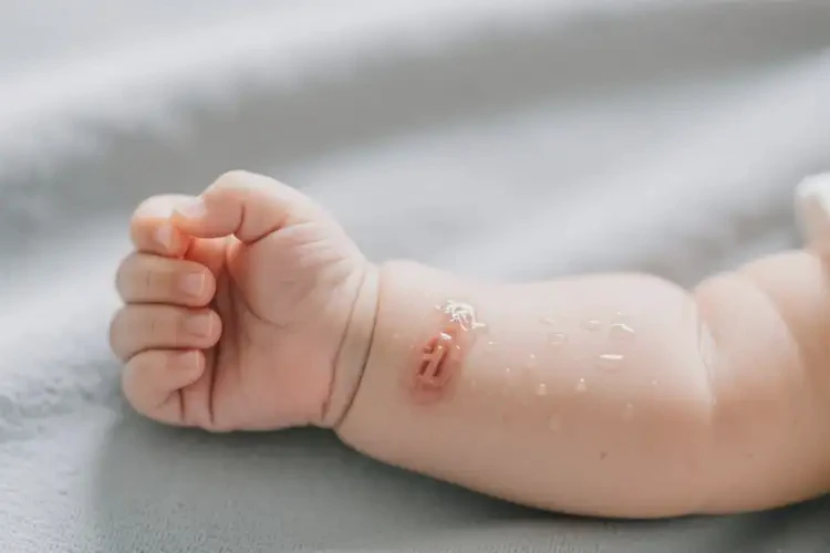 婴儿手臂上经常起湿疹能够彻底治愈吗(图3)