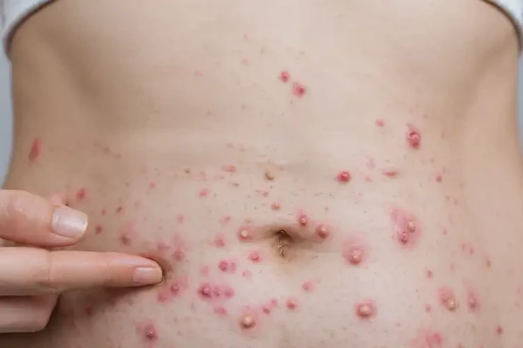 女性肚子上有濕疹能夠徹底治愈嗎(圖4)