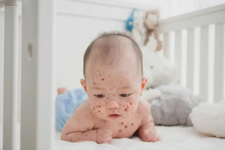 宝宝全身出湿疹可不可以彻底自愈(图4)