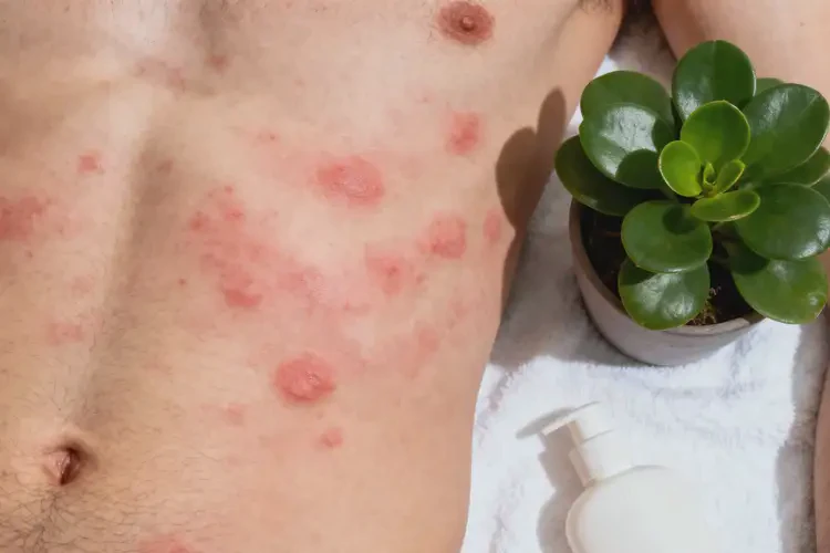 男生肚子出濕疹可不可以徹底自愈(圖3)