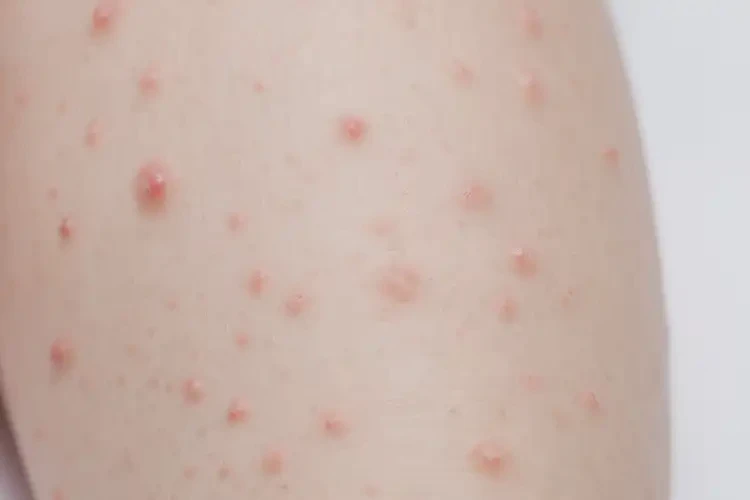 幼兒小腿上偶爾長(zhǎng)濕疹不管它會(huì)自己痊愈嗎(圖4)