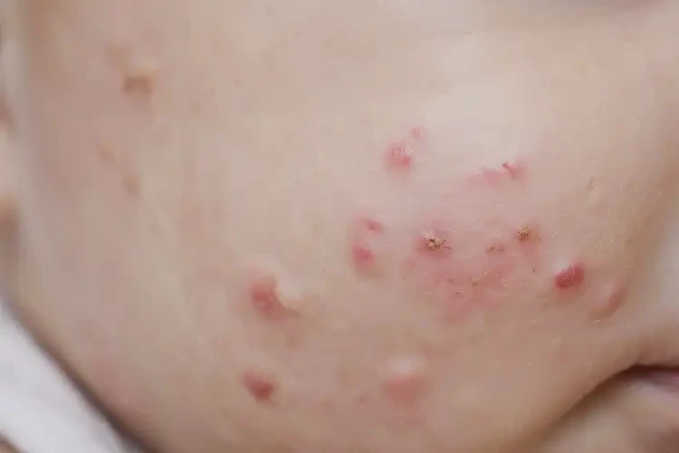 幼兒屁股上出現(xiàn)濕疹可以徹底自愈嗎(圖4)