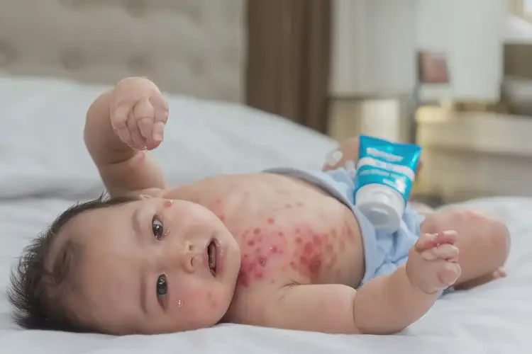 寶寶脖子偶爾長濕疹能夠徹底治愈嗎(圖4)