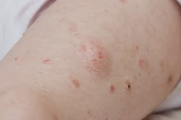 小兒大腿上出現(xiàn)濕疹不管它會自己好嗎(圖4)