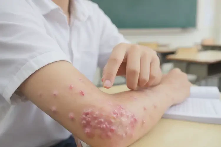 中學生手臂上長濕疹不管它會自己好嗎(圖3)