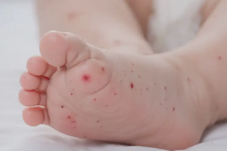 寶寶腳上出現(xiàn)濕疹不管它會自己自愈嗎(圖4)