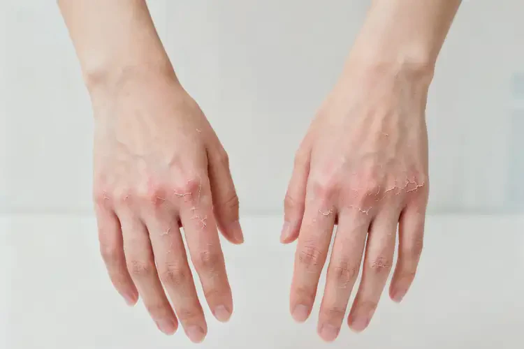 女性手上偶爾起濕疹可以徹底自愈嗎(圖4)