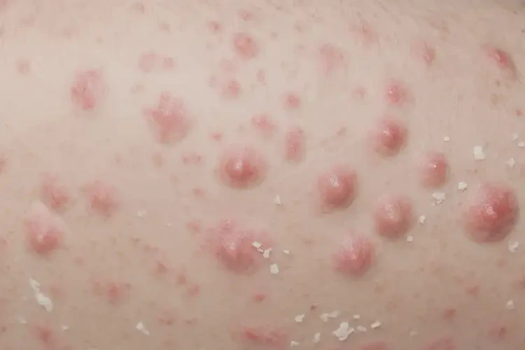 男生大腿出現(xiàn)濕疹能徹底自愈嗎(圖3)