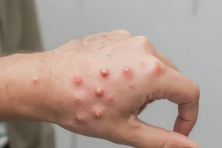 青年人四肢經(jīng)常起濕疹可以徹底自愈嗎(圖4)