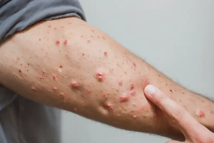 男性手臂容易长湿疹不管它会自己痊愈吗(图4)