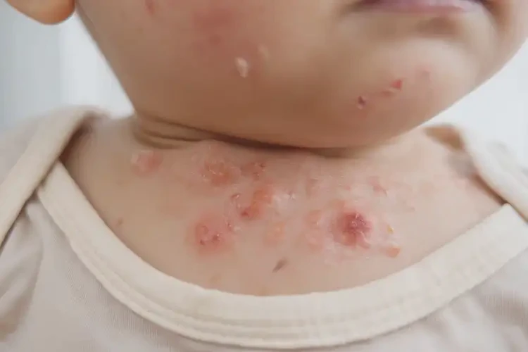 嬰幼兒脖子上有濕疹不管它會(huì)自己自愈嗎(圖4)