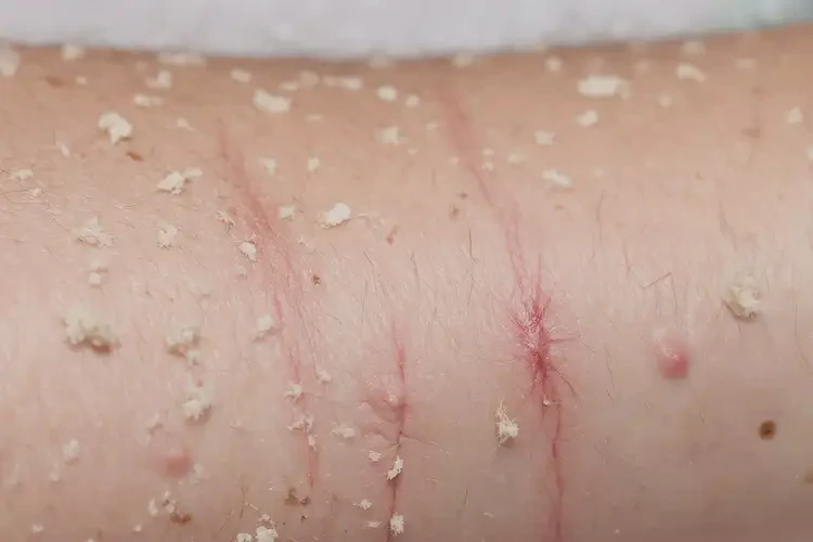 小孩手臂長濕疹能靠自己自愈嗎(圖3)