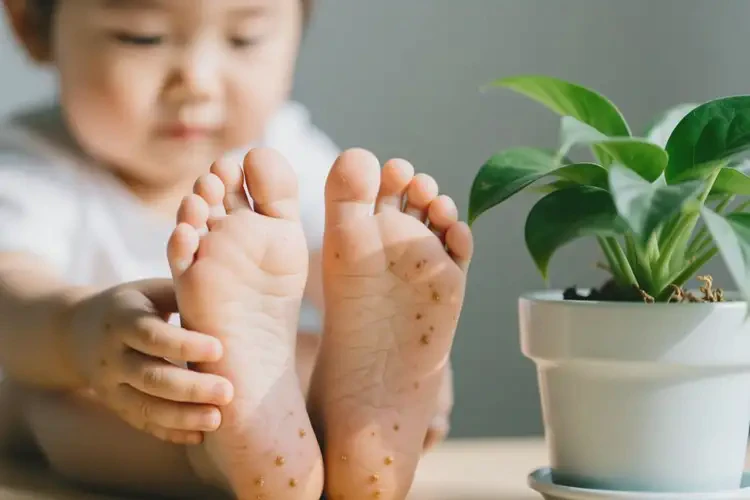 小孩腳上偶爾長濕疹可以徹底自愈嗎(圖3)