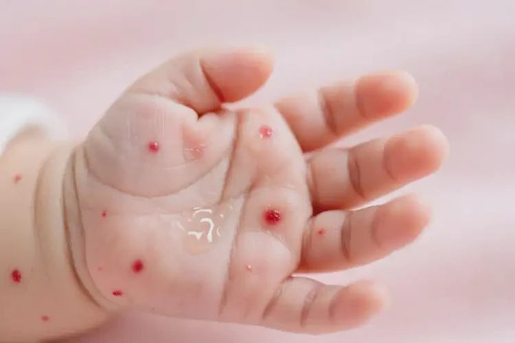 嬰兒手上出現(xiàn)濕疹能夠徹底治愈嗎(圖1)