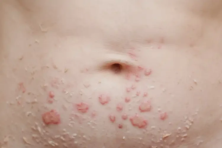 女生肚子偶爾長(zhǎng)濕疹不管它會(huì)自己痊愈嗎(圖4)