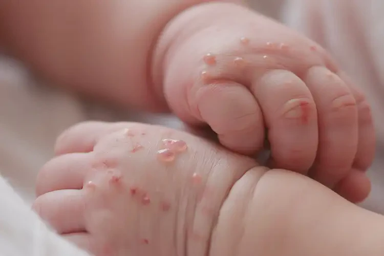 新生兒手上出現(xiàn)濕疹不管它會(huì)自己痊愈嗎(圖4)