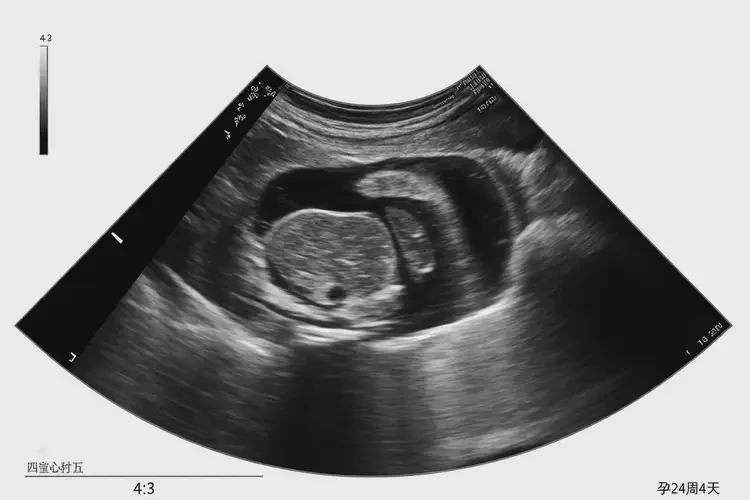 孕24周4天胎心率164寶寶還能要嗎(圖4)