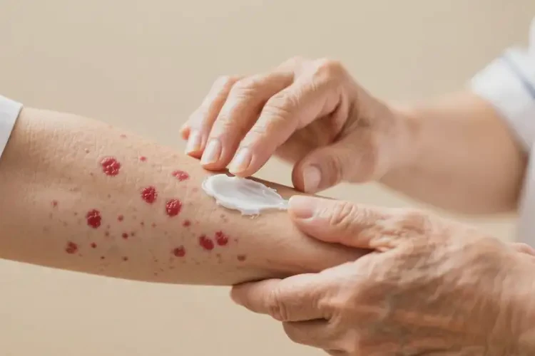 老人手臂经常起湿疹不管它会自己好吗(图4)