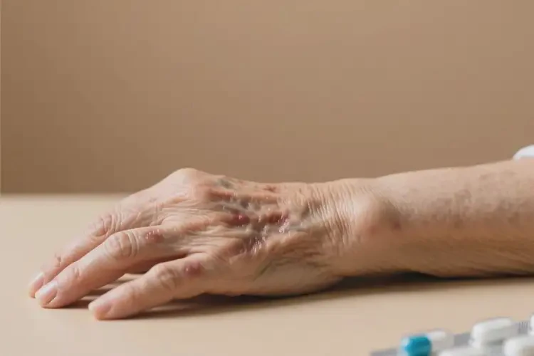 老年人手臂上偶爾起濕疹能不能徹底自愈(圖2)