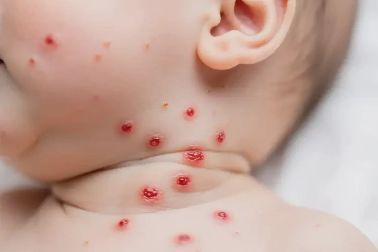 小儿脖子经常起湿疹不管它会自己好吗(图4)