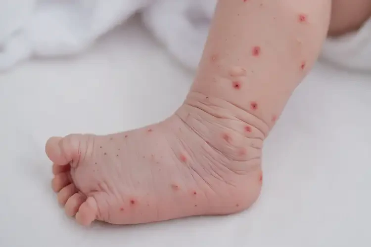 新生兒小腿偶爾起濕疹能靠自己自愈嗎(圖4)