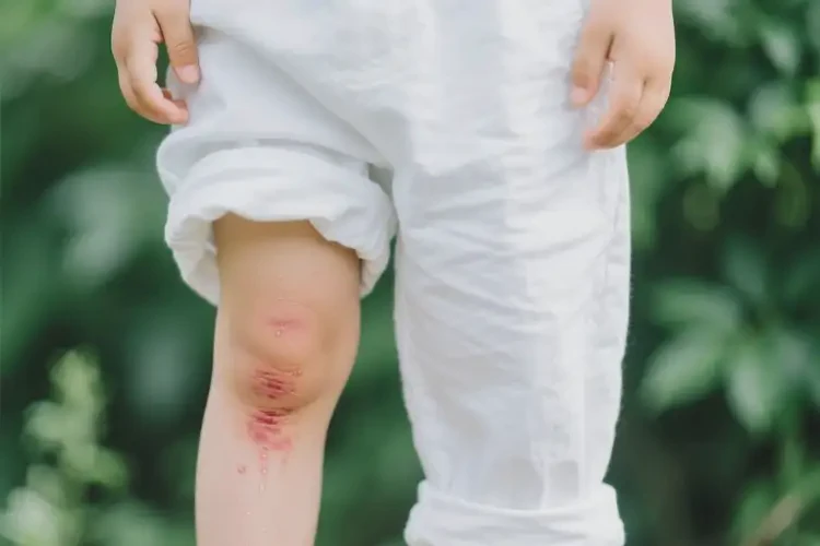 少儿大腿上容易长湿疹不管它会自己自愈吗(图1)