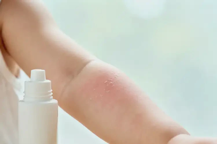 幼兒手臂偶爾起濕疹可以徹底自愈嗎(圖1)