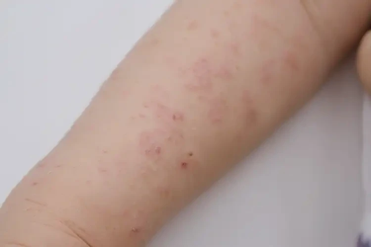 孩子手臂上有濕疹能靠自己自愈嗎(圖4)