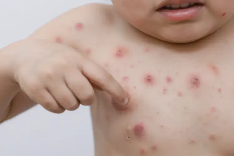 小孩手臂上偶爾起濕疹能徹底自愈嗎(圖4)