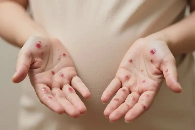 產(chǎn)婦手上經(jīng)常起濕疹不管它會自己自愈嗎(圖4)