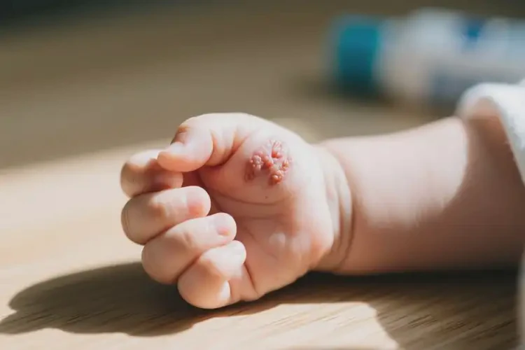 嬰兒手上起濕疹不管它會自己痊愈嗎(圖3)
