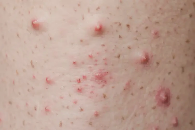 老人肛周出濕疹不管它會(huì)自己自愈嗎(圖4)