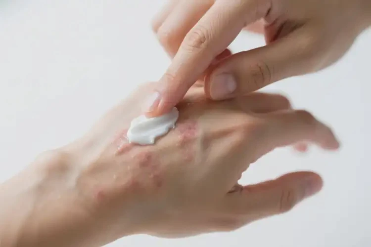 男生手上容易長濕疹能徹底自愈嗎(圖3)