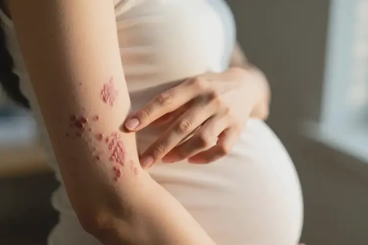 產(chǎn)婦手臂上起濕疹能徹底自愈嗎(圖2)