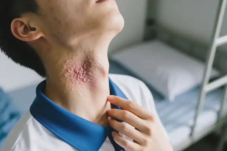 大學生脖子出現(xiàn)濕疹不管它會自己好嗎(圖1)