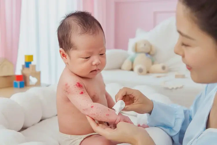 新生兒身上出濕疹不管它會自己痊愈嗎(圖3)