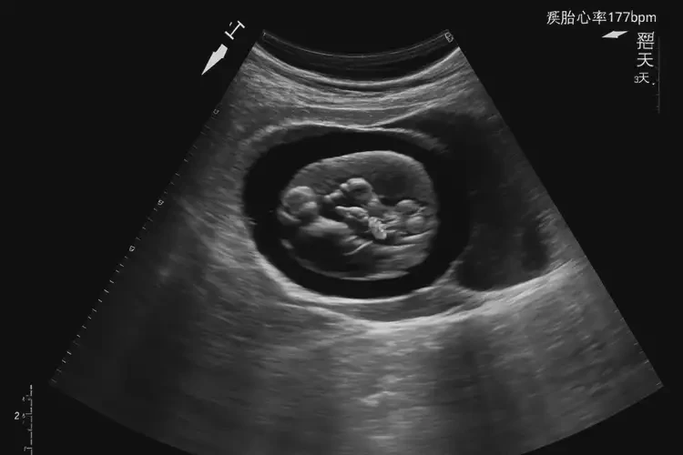 孕5周3天胎心率177還能保住嗎(圖4)