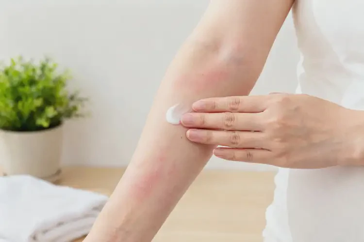 哺乳期媽媽手臂有濕疹能不能徹底自愈(圖2)